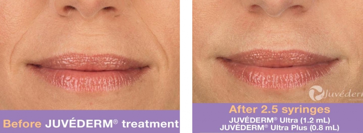 Juvederm - Before & After 2