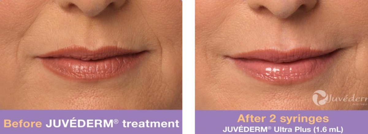 Juvenderm - Before & After 3
