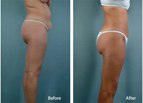 Denver Liposuction Patient Before and After Results