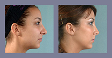 cta-gallery-rhinoplasty_0