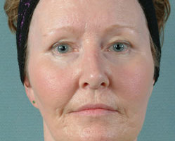 Facelift in Littleton, Highlands Ranch and Denver