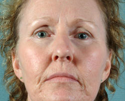 facelift-pt1-before-front