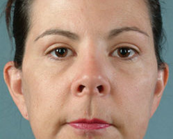 Facelift in Littleton, Highlands Ranch and Denver