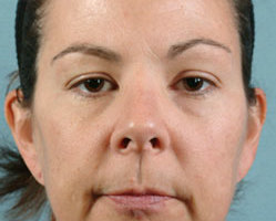 Facelift in Littleton, Highlands Ranch and Denver