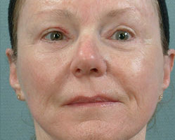 facelift-pt3-after-front