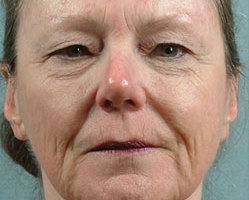 Facelift, Upper & Lower Lid Blepharoplasty, TCA Facial Peel
