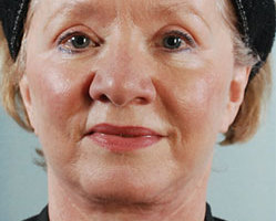 Facelift in Littleton, Highlands Ranch and Denver