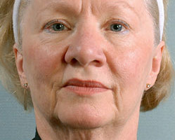 Facelift in Littleton, Highlands Ranch and Denver