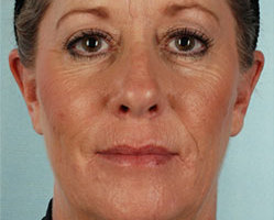Facelift in Littleton, Highlands Ranch and Denver