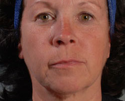Facelift in Littleton, Highlands Ranch and Denver