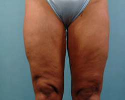 Liposuction in Denver, Highlands Ranch and Littleton