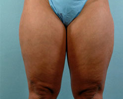 Liposuction in Denver, Highlands Ranch and Littleton