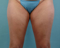 Liposuction in Denver, Highlands Ranch and Littleton