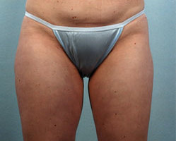 Liposuction in Denver, Highlands Ranch and Littleton