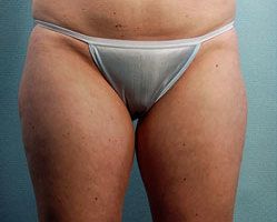 Liposuction in Denver, Highlands Ranch and Littleton