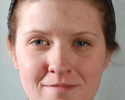 Otoplasty in Littleton, Highlands Ranch and Denver